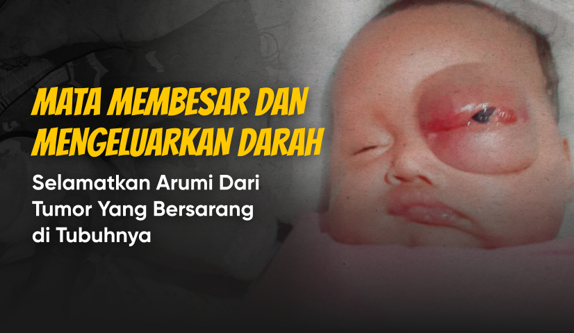 Idap Tumor Mata, Bantu Anak Kuli Bangunan Bisa Lakukan Pengobatan