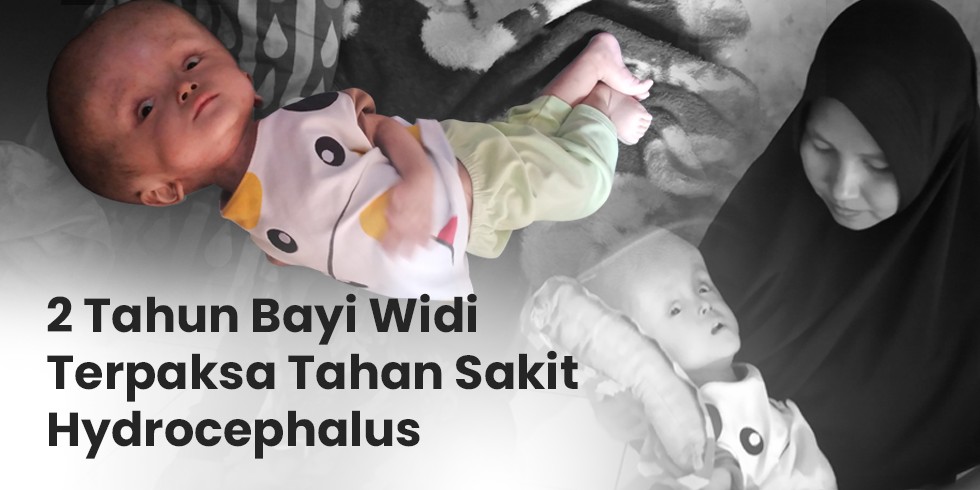 2 Tahun Tanpa Sentuhan Medis Kepala Bayi Widi Semakin Membesar