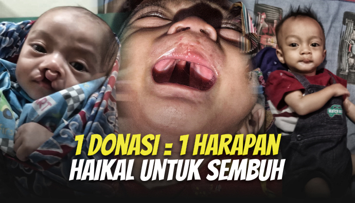 Alami Bibir Sumbing, Bantu Haikal Lakukan Pengobatan