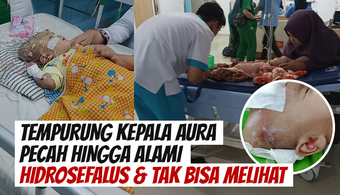 Ditelantarkan Orang Tua, Bantu Balita Hidrosefalus Ini Berobat