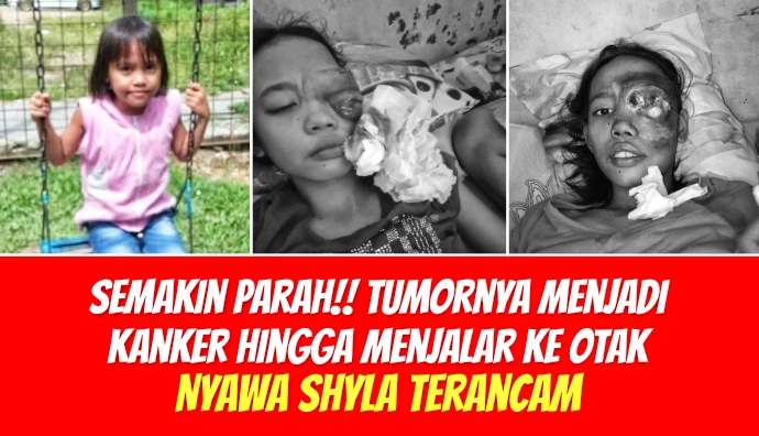 Mata Semakin Membesar, Shyla Butuh Biaya Jutaan Untuk Berobat
