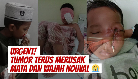 Tumor di Wajah, Bantu Nouval Berjuang Untuk Sembuh