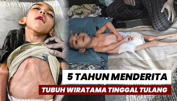 Tubuh Semakin Kurus, Bocah 5 Tahun Ini Idap Lumpuh Otak