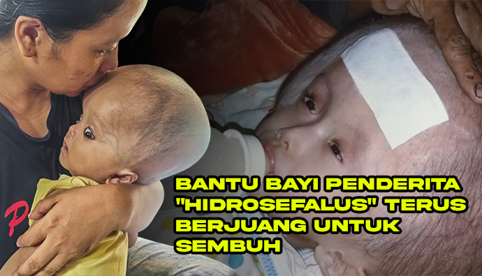 Penuhi Gizi dengan Sedekah Untuk 1.000 Anak Hidrosefalus