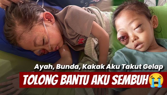 Mata Bocah 5 Tahun Membesar Akibat Kanker Darah