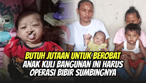 Alami Bibir Sumbing, Bantu Bayi 2 Bulan Ini Sembuh