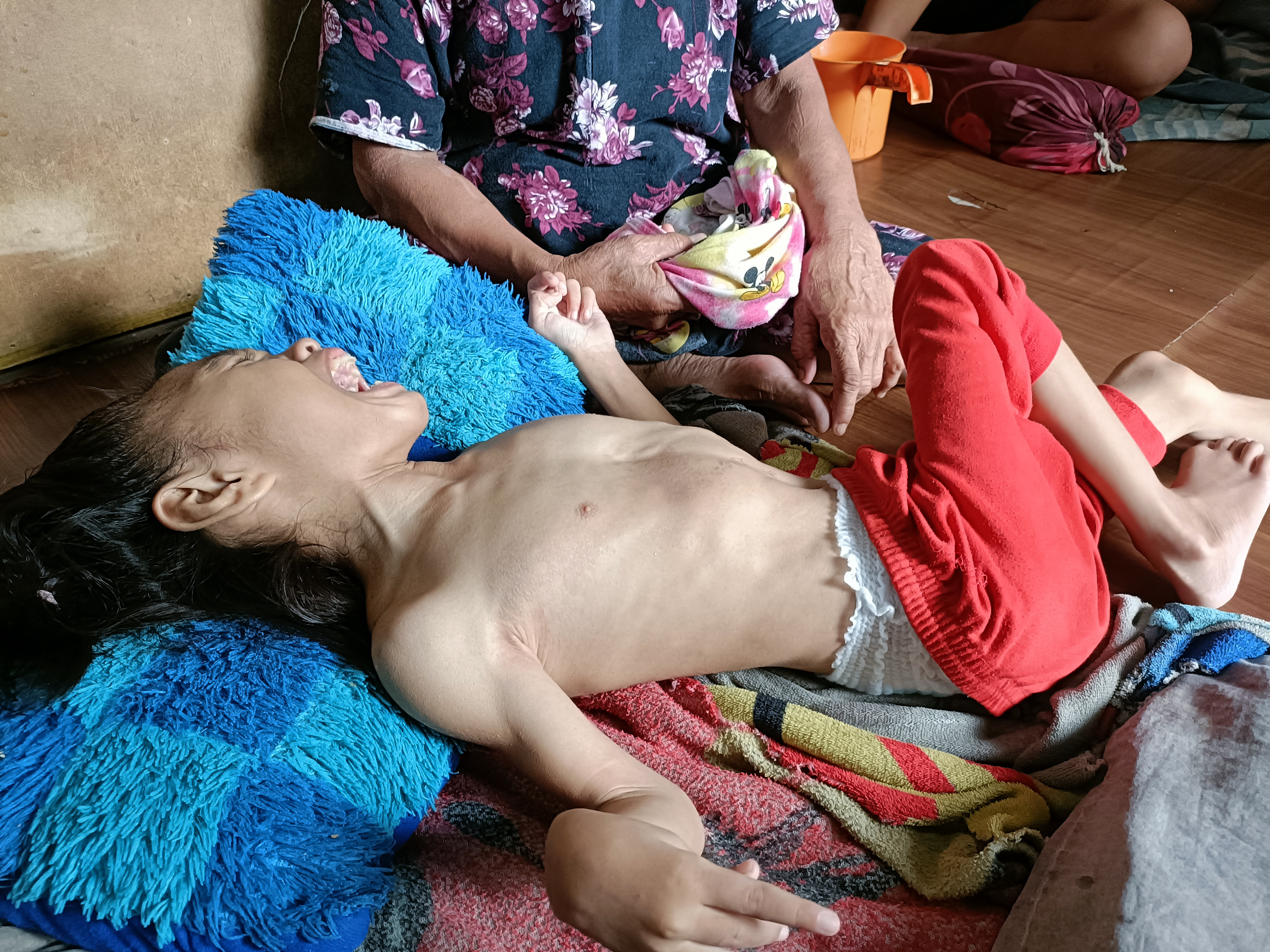 Sering Kelaparan, Ziyana Bertahan di Tengah Kekurangan Gizi