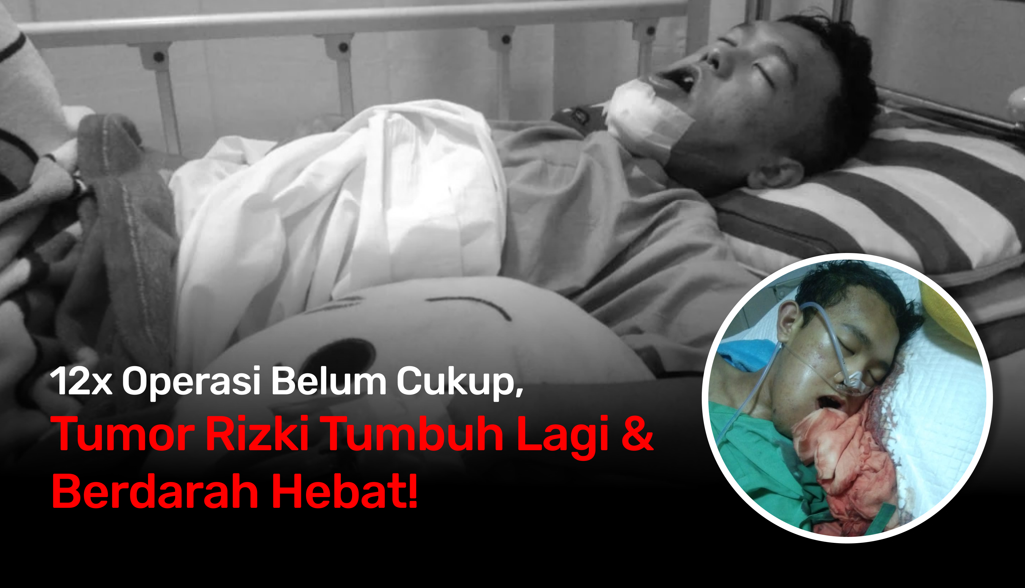 Tumor Kembali Tumbuh, Rizki Butuh Operasi Segera