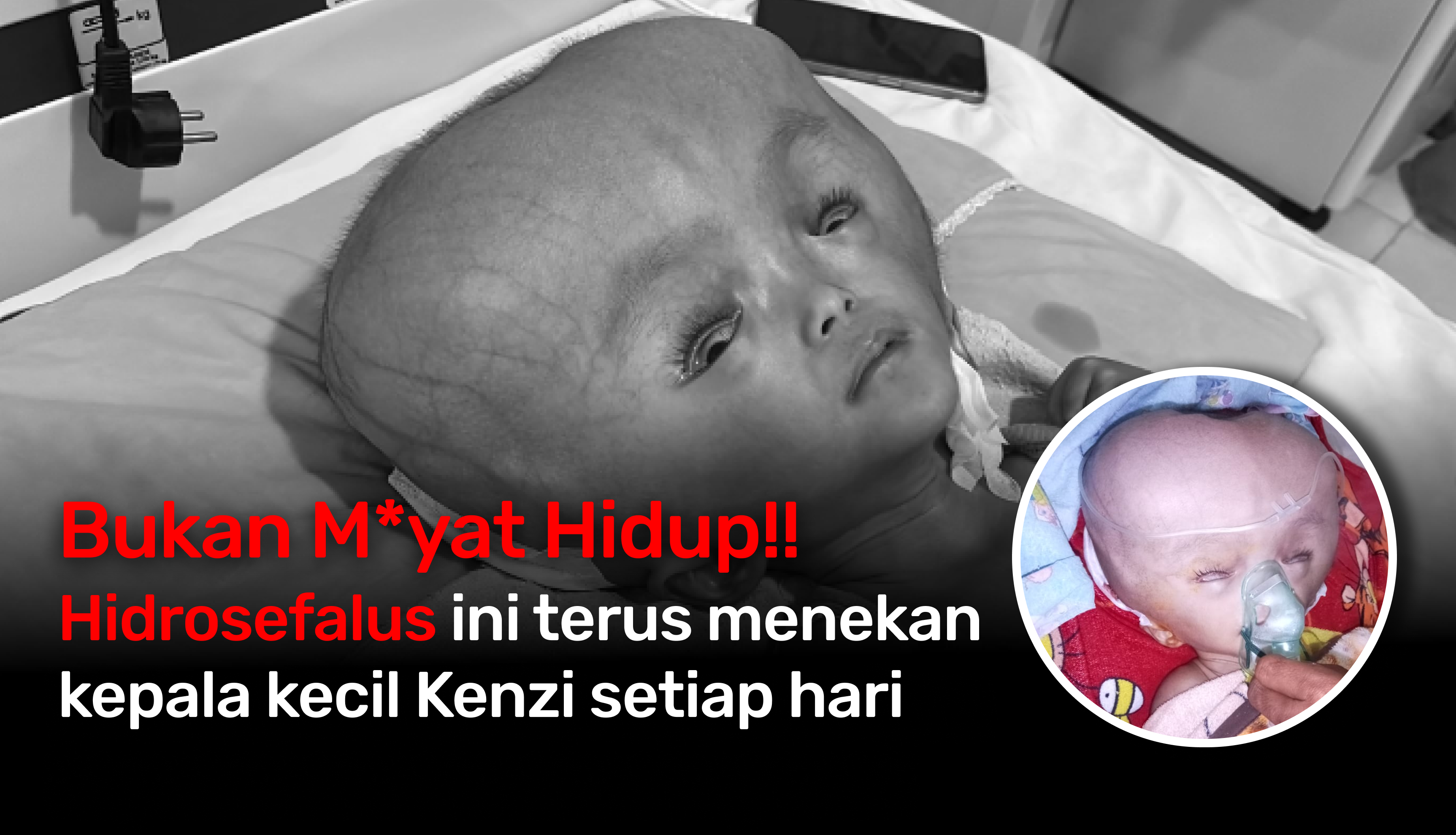 Terkendala Biaya, Bantu Anak Hidrosefalus Ini Berobat