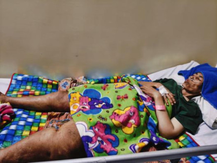 Melawan Kanker, Bantu Bu Hartini Sembuh Demi Anaknya