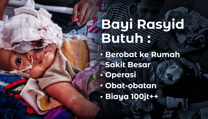 Bantu Bayi 7 Bulan Ini Idap Tumor Ganas di Matanya