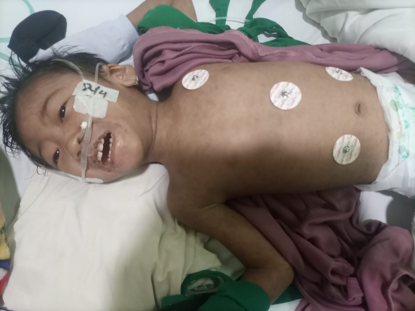 Butuh Terapi dan Pengobatan Rutin, Bantu amara (3) Bertahan Hidup