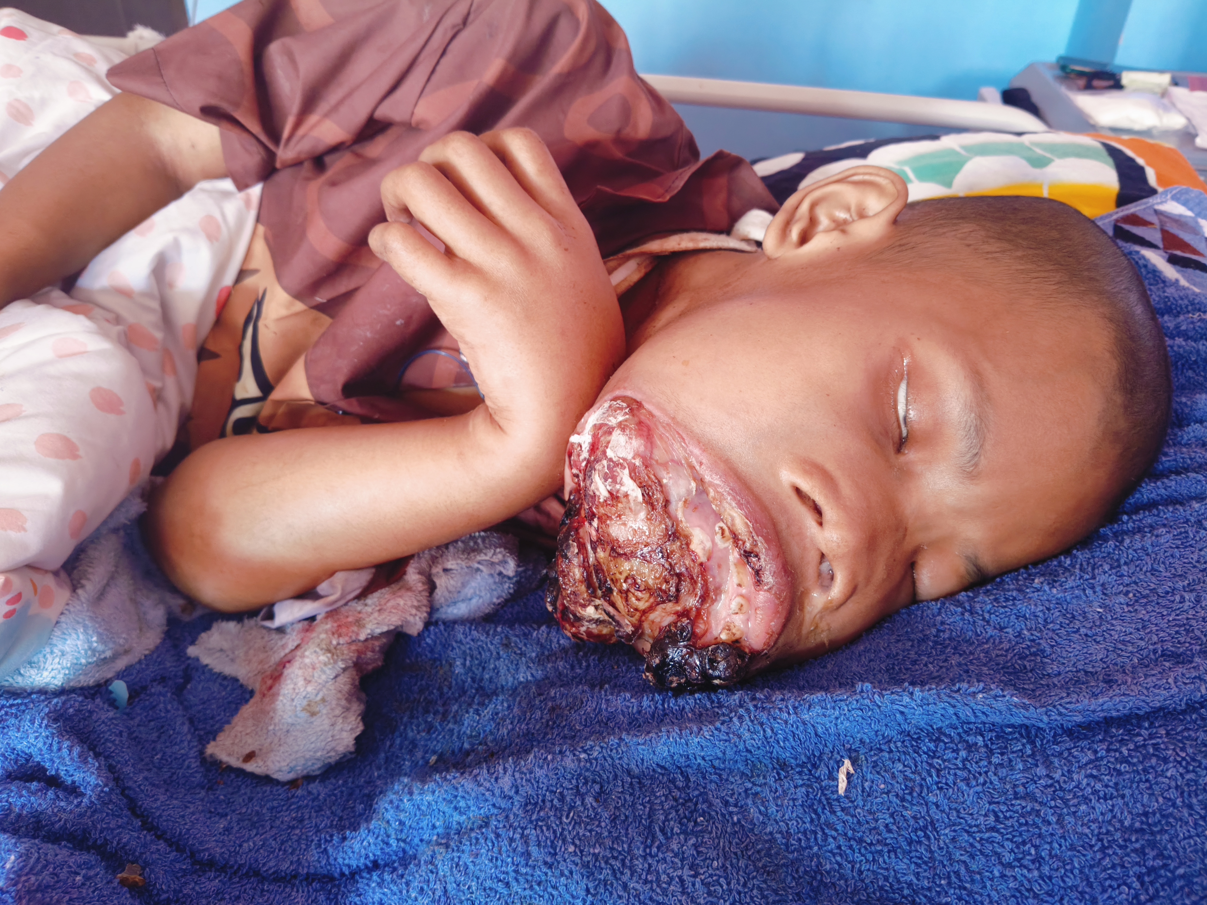Benjolan Semakin Membesar ! Bantu Yatim Ini Sembuh