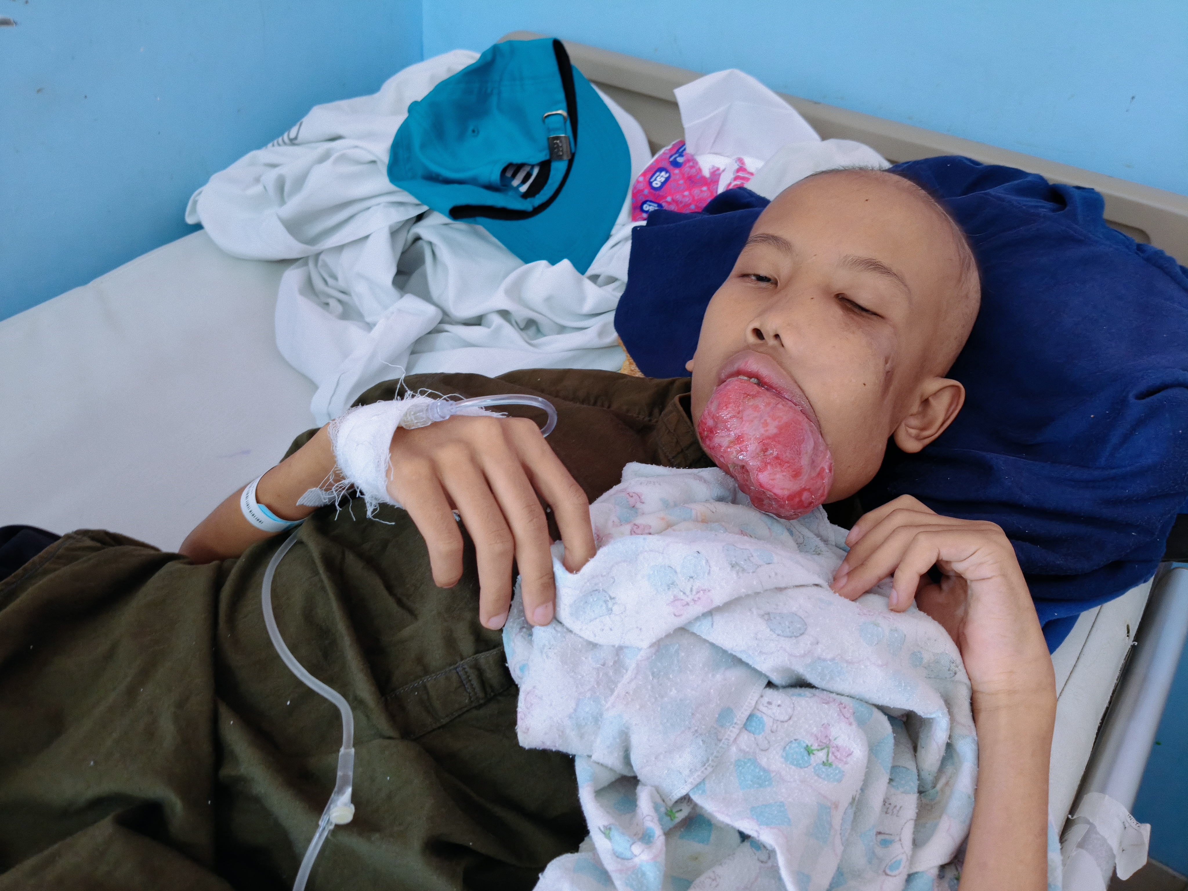 Tumor Membesar! Dani Kesulitan Makan dan Berbicara