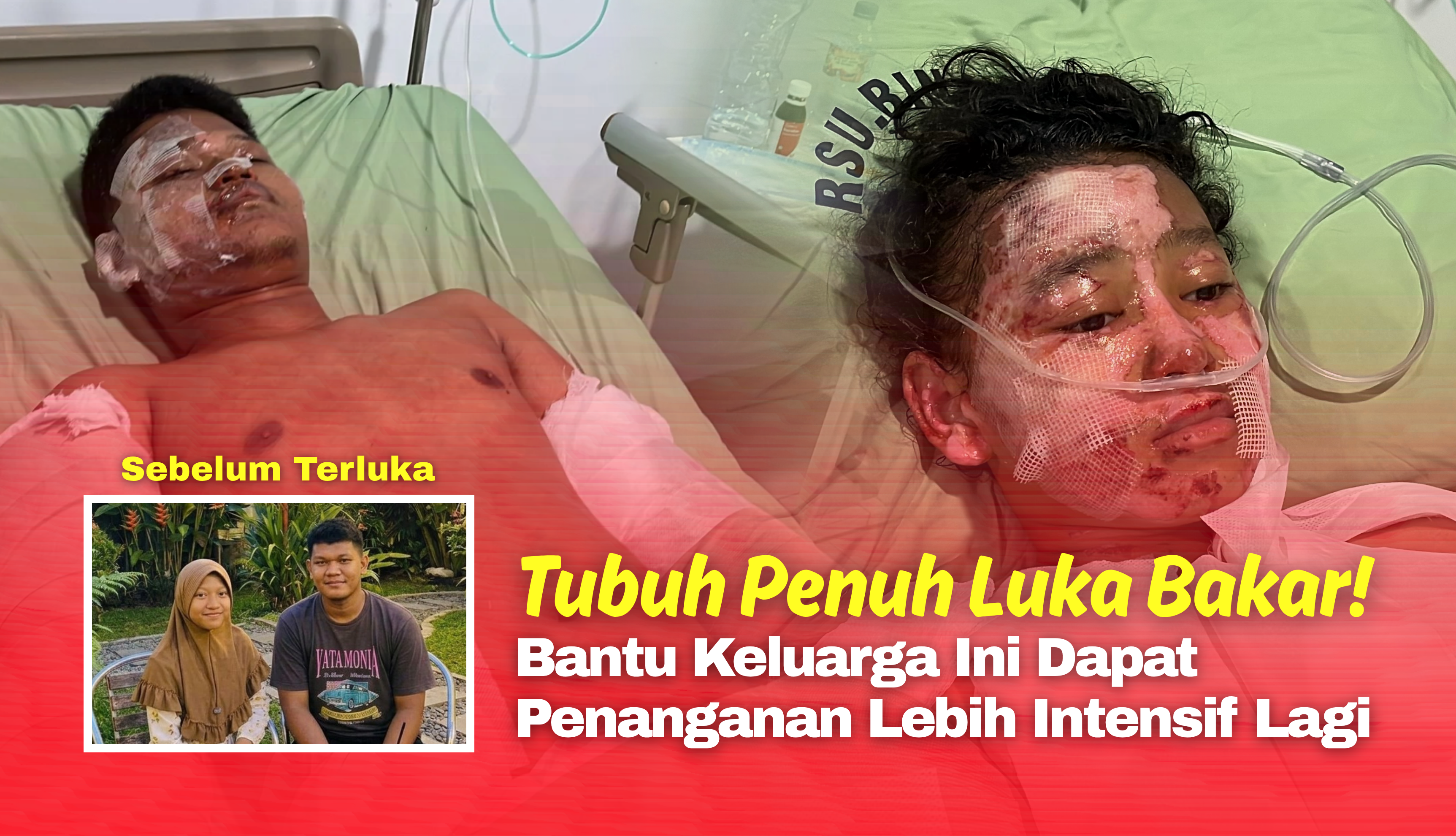 Idap Luka Bakar 73%, Talita Menangis Setiap Hari