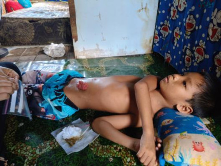 2 dari 3 Anak Buruh Angkut Beras Alami Kelainan