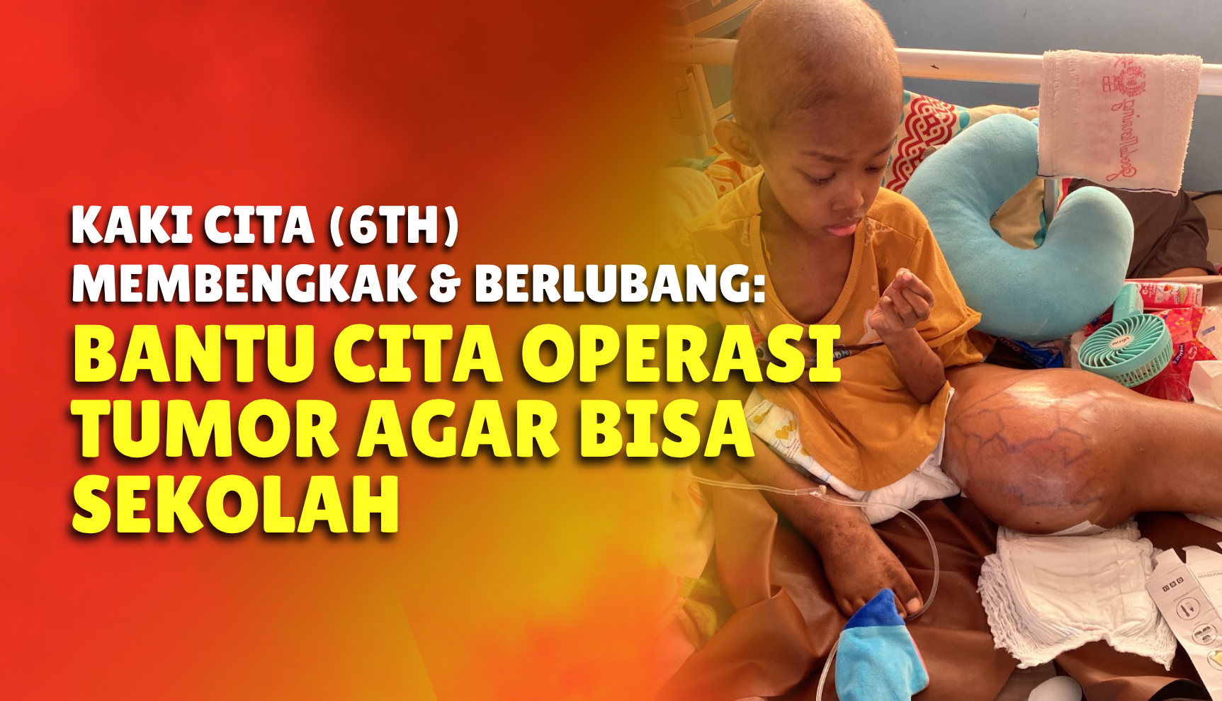 Tumor Tumbuh di Kaki, Cita Butuh Operasi Kedua