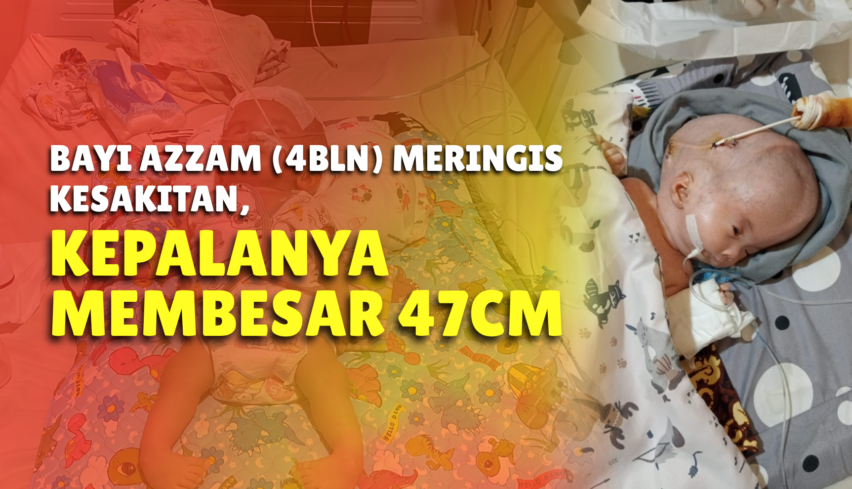 Sering Kejang, Bayi Hidrosefalus Ini Butuh Operasi Segera